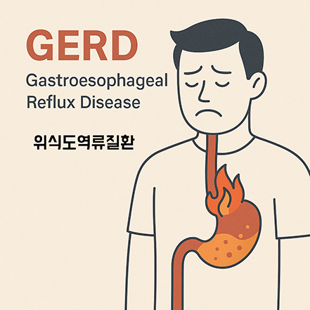 GERD(위식도역류질환)를 앓고 있는 남성이 불편한 표정을 짓고 있으며, 식도와 위에서 위산이 역류하는 모습을 보여주는 일러스트