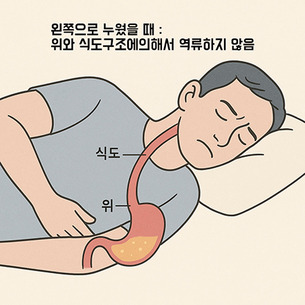 왼쪽으로 누운 남성이 위산 역류 없이 편안한 자세를 취하고 있으며, 위와 식도의 구조가 표시된 일러스트와 함께 “왼쪽으로 누웠을 때: 위와 식도 구조에 의해서 역류하지 않음”이라는 문구가 포함된 교육용 이미지