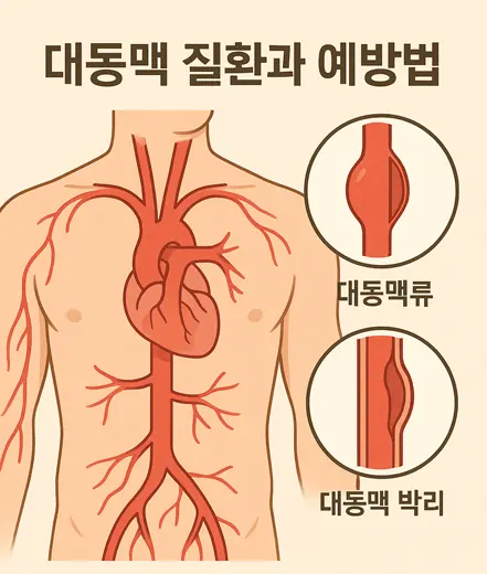대동맥 질환과 예방법 인포그래픽 - 대동맥류와 대동맥 박리 그림