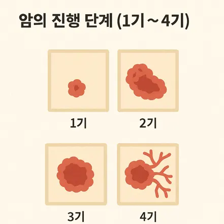 암 진행 단계를 1기부터 4기까지 보여주는 인포그래픽 \n제목: 암의 진행 단계 (1기~4기)