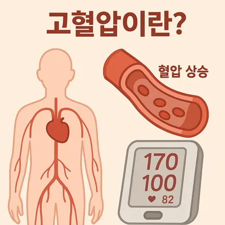 심장, 혈관, 혈압계 이미지를 통해 혈압이 높아진 상태인 고혈압을 설명하는 인포그래픽